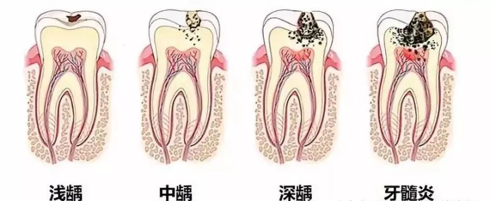 龋齿患病率高达709罪魁祸首竟是它